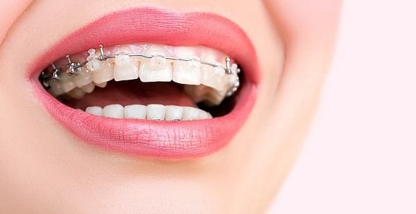 از بین بردن جرم دندان ارتودنسی