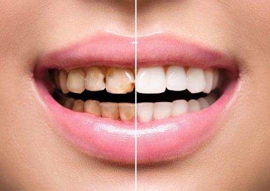 چه زمانی بايد لمینت دندان را تعویض کنیم؟
