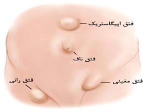 فتق
