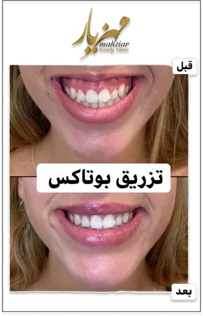 تزریق بوتاکس برای درمان گامی اسمایل