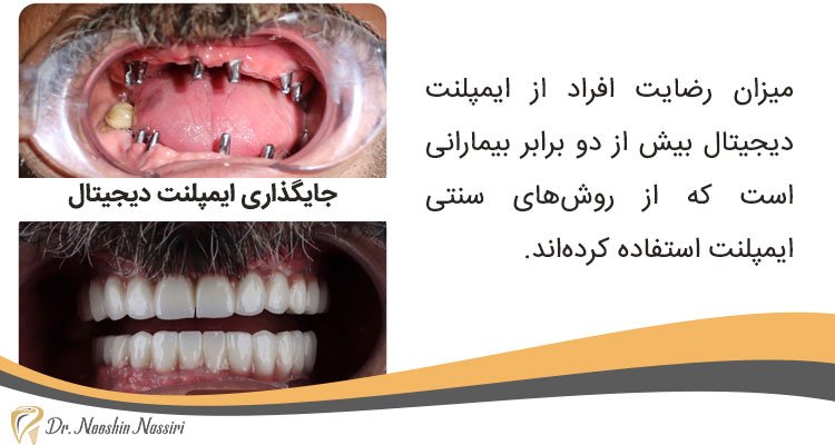 ایمپلنت دیجیتال دندان