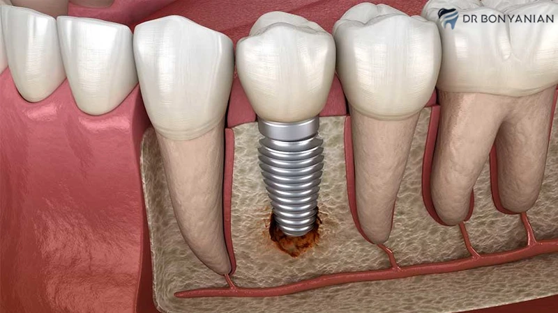 عمر ایمپلنت دندان - تصویر 1