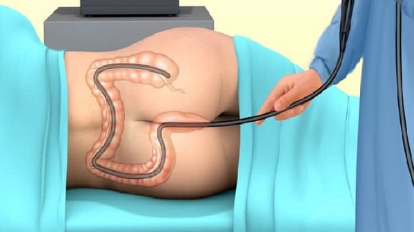 آمادگی برای کولونوسکوپی چگونه است؟