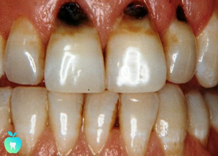 پوسیدگی دندان