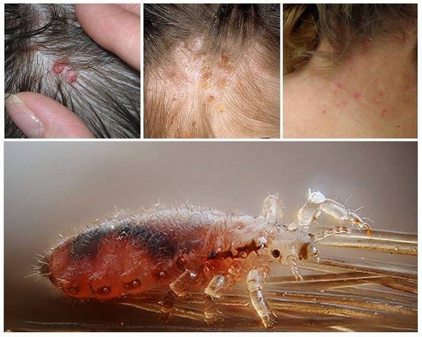 علائم شپش سرچیست؟