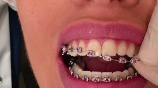 مدت زمان لازم برای اصلاح دندان ها به روش ارتودنسی