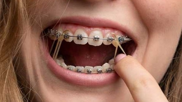 هزینه های ارتودنسی دندان در سال جدید