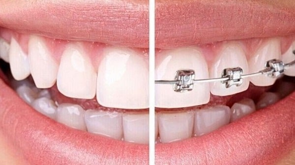  ارتودنسی دندان فاصله دار