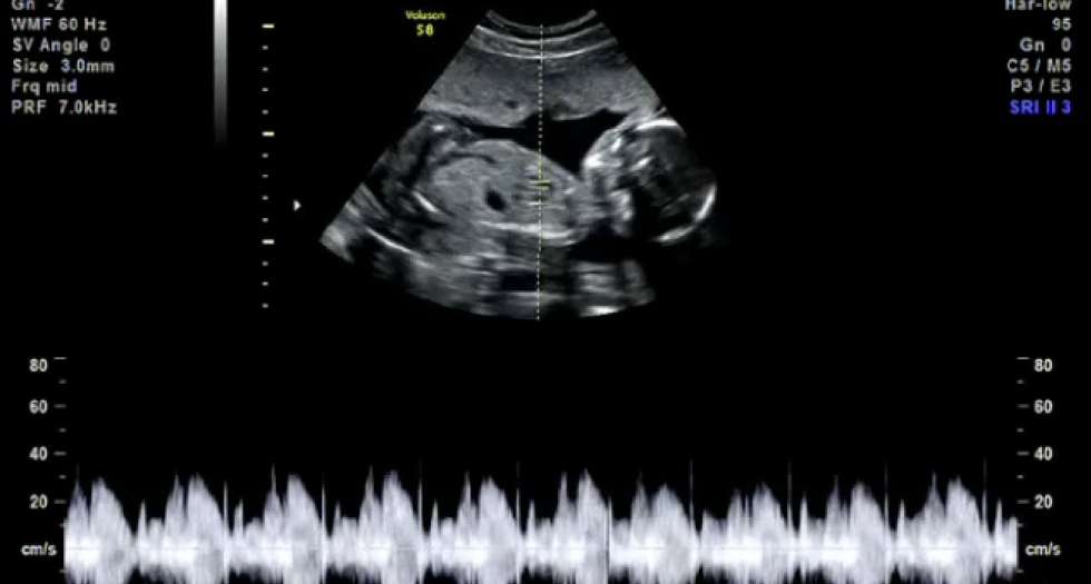 جدول وزن گیری جنین پسر و دختر