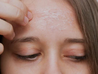 کمبود کدام ویتامین باعث خارش بدن میشود ؟