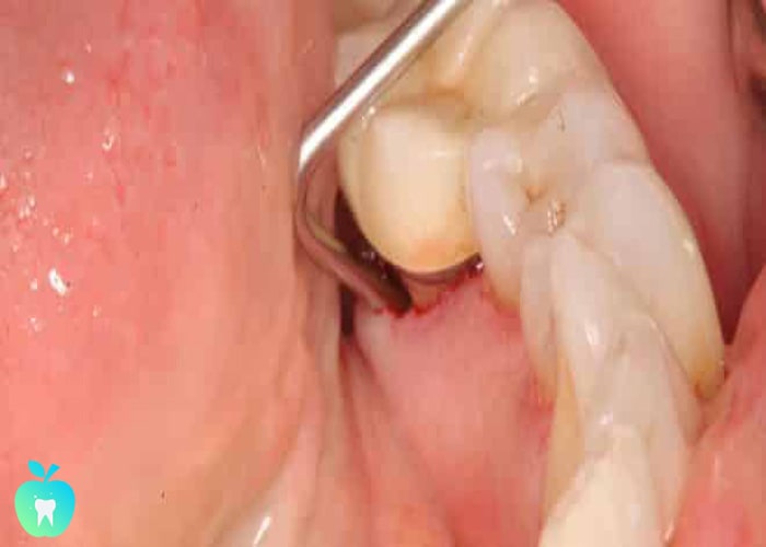 راه های درمان آبسه یا عفونت دندانی