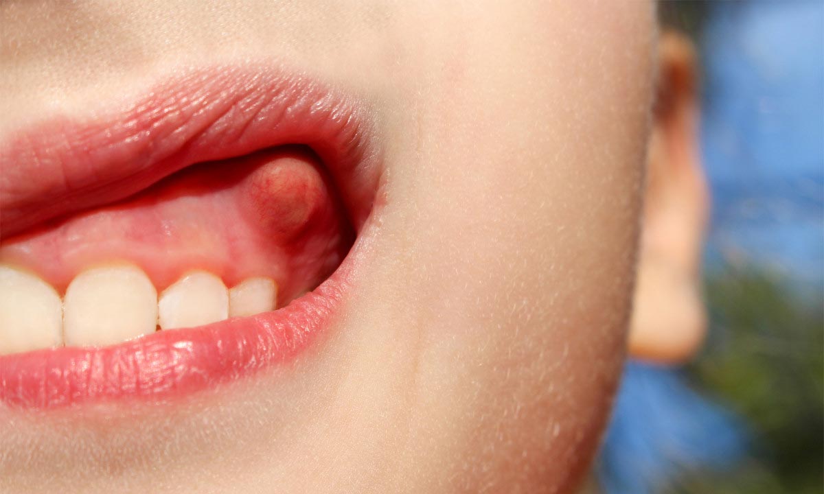 _رازهای پنهان دهان_ آبسه دندان، نشانگر چه چیزهای مخفی در دهان می باشد؟ _ - تصویر 3