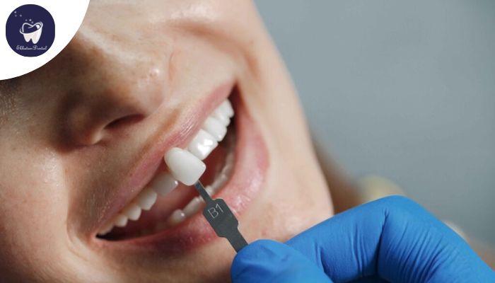 نصب دقیق لمینت دندان برای پیشگیری از آسیب و حساسیت