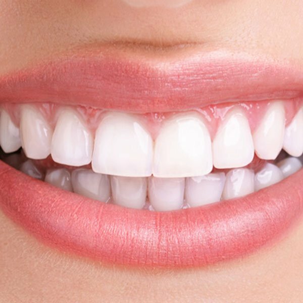 روش خانگی برای صاف شدن دندان های کج و علت آن
