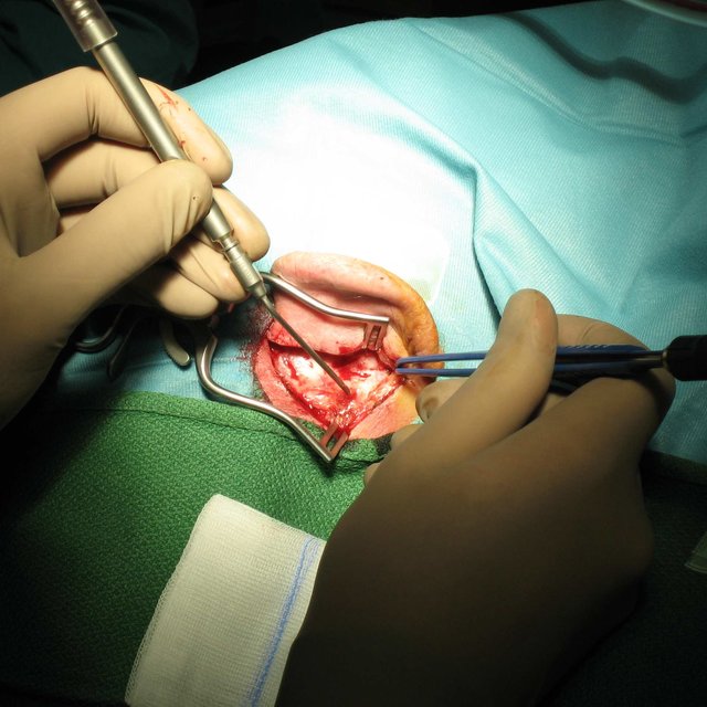 پانسمان گوش بعد از عمل استخوانچه