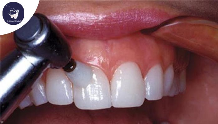 پولیش لمینت دندان برای درخشش و حفظ سلامت بدون آسیب