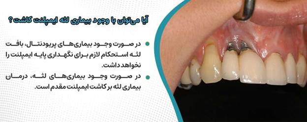 آیا بیماریهای لثه مانع ایمپلنت هستند؟