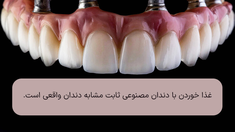 همه چیز در مورد دندان مصنوعی ثابت