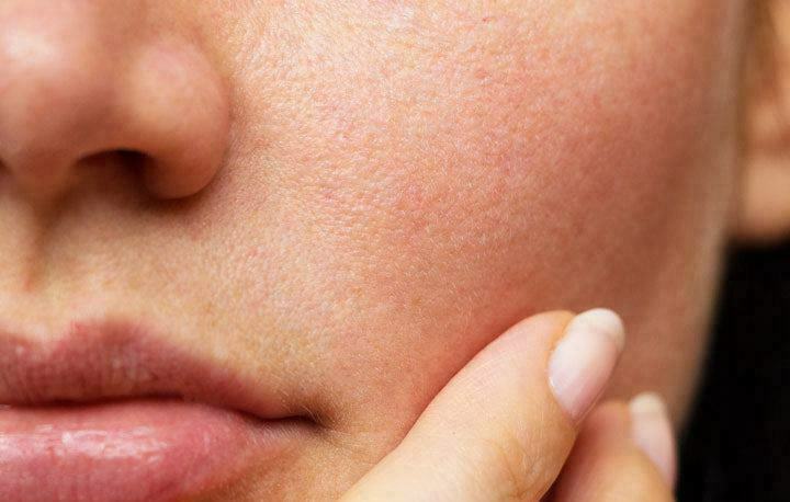 بهترین درمان قطعی منافذ باز پوست صورت چیست؟