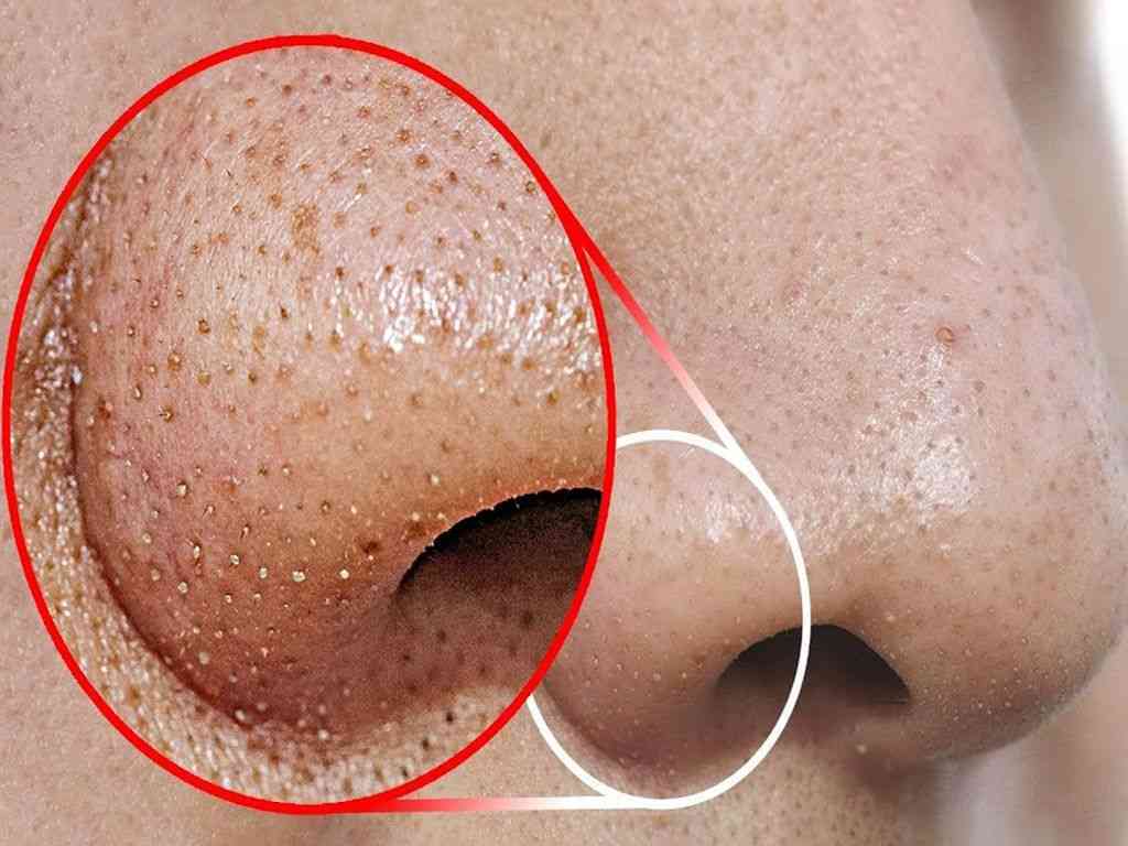 علت دانه های سیاه روی بینی