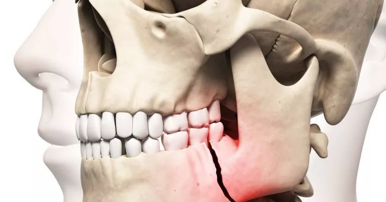 بیرون زدن و شکستن استخوان هنگام کشیدن دندان نیش